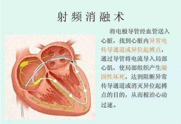 房颤射频消融术心脏手术的现代艺术